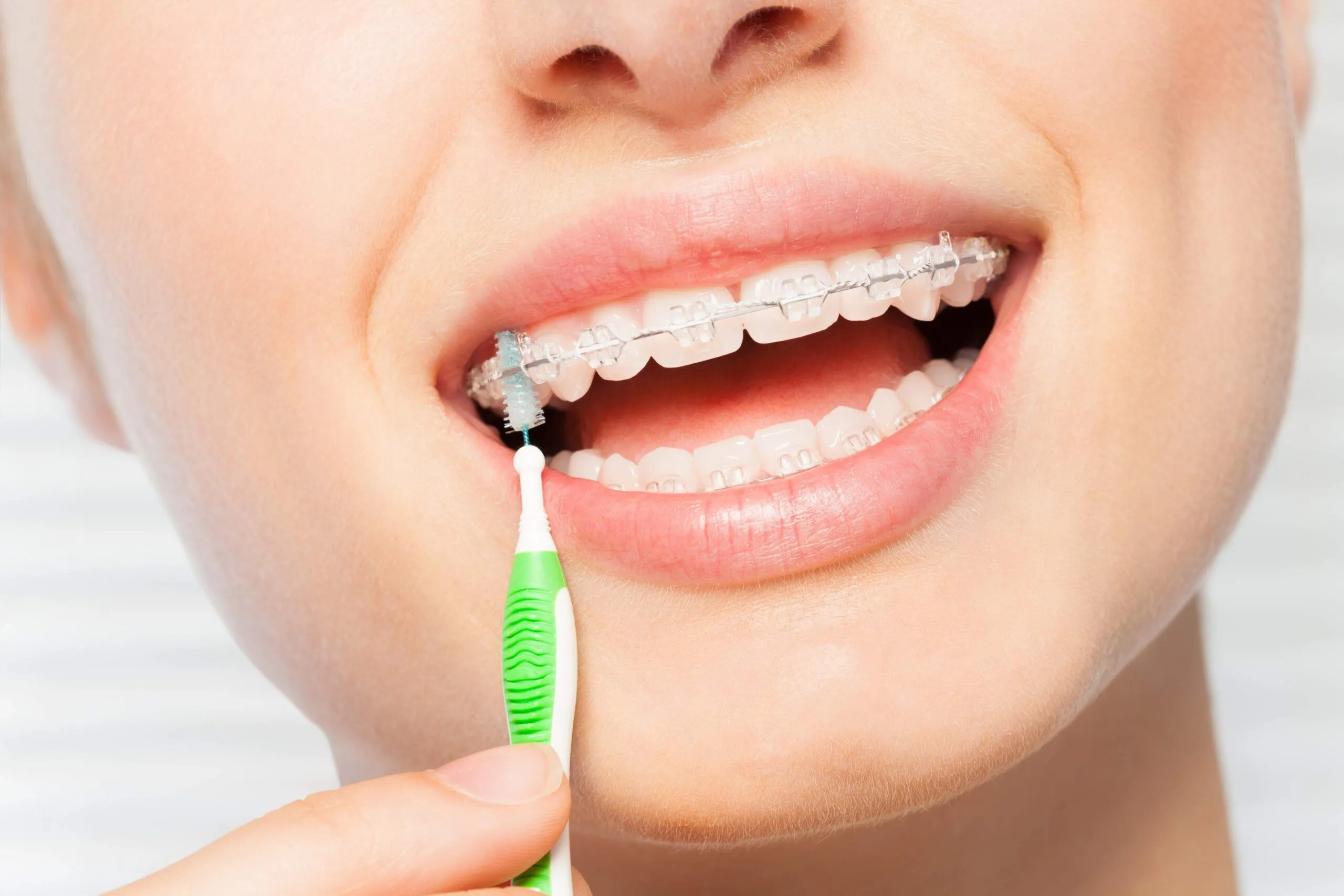 Close-up of ceramic braces